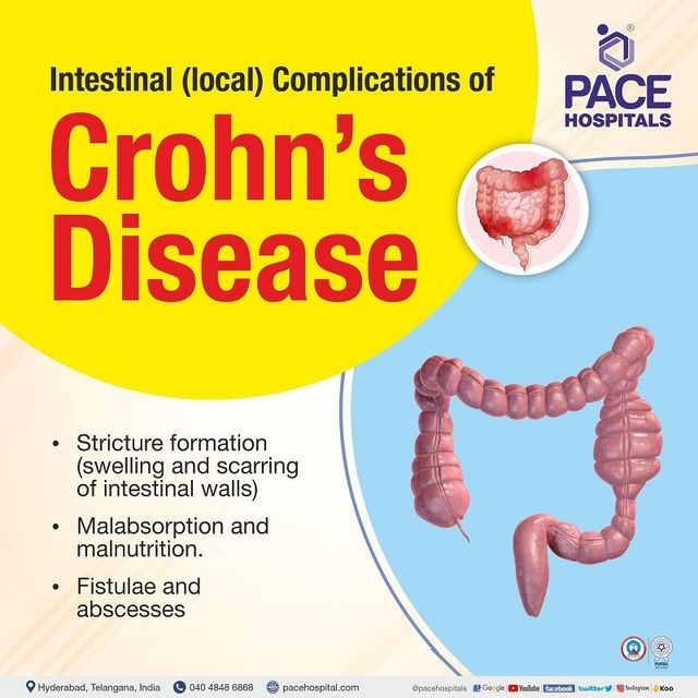 Crohn s Disease Symptoms Causes Complications Prevention